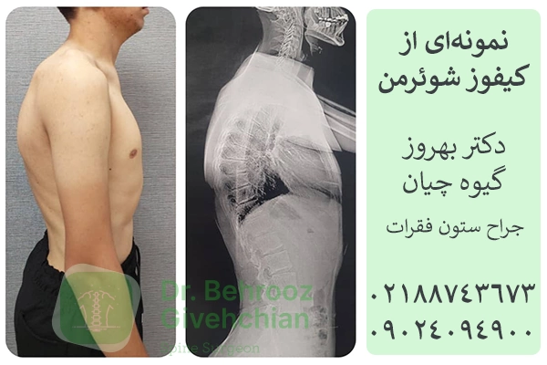 انحراف ستون فقرات؛ کیفوز