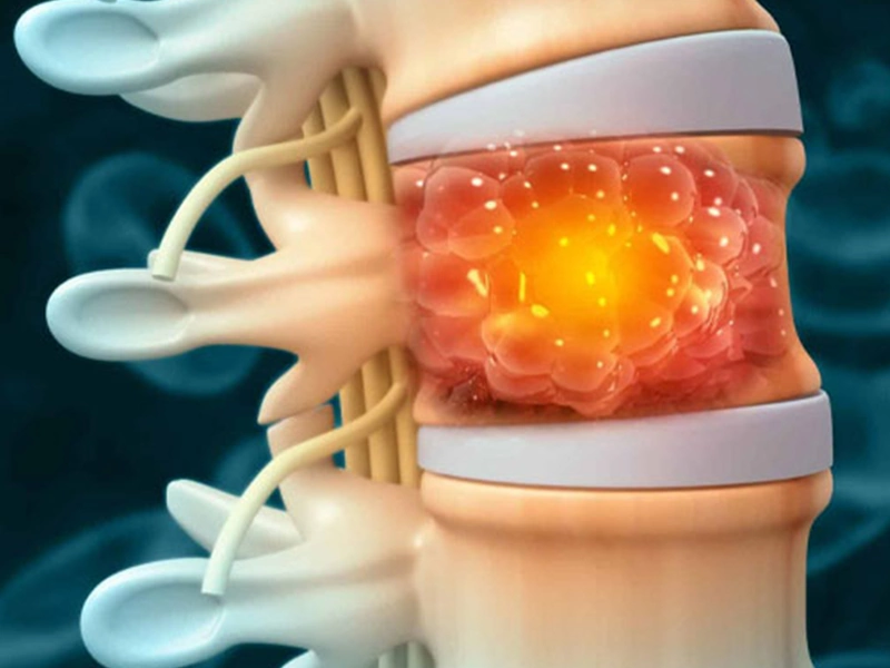درمان تومور ستون فقرات