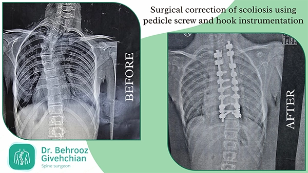 جراحی انحرافات ستون مهرهها با سیستم پیچ پدیکولار