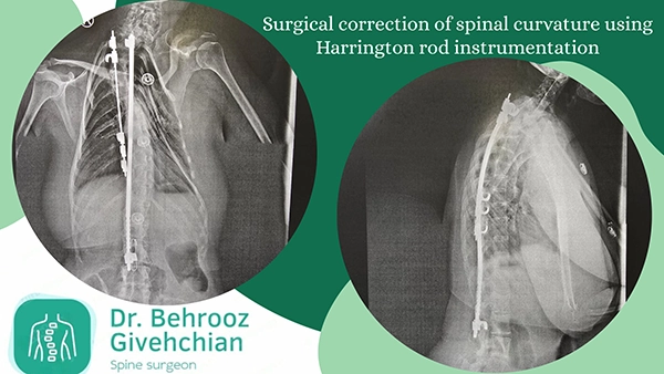 جراحی انحرافات ستون فقرات به روش هارینگتون