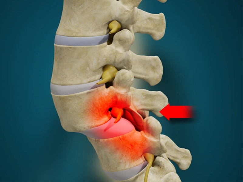 جراحی سرخوردگی مهره