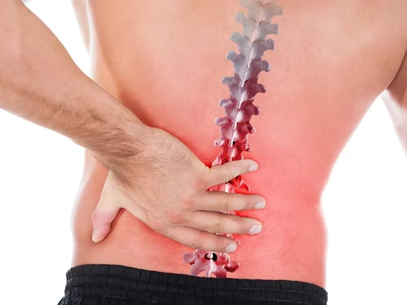 درمان دیسک کمر