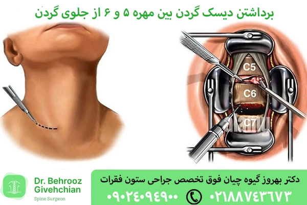 دیسککتومی گردن