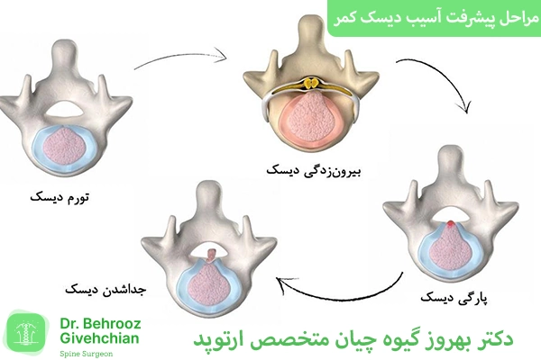 مراحل آسیب دیسک کمر
