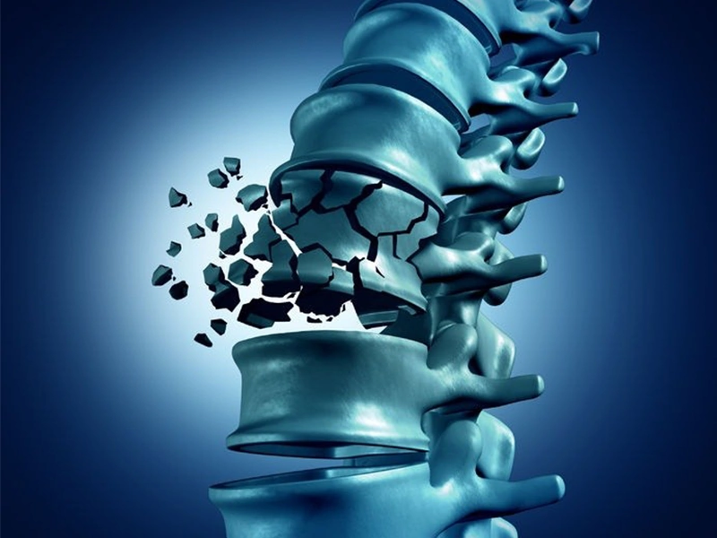 شکستگی تروماتیک ستون فقرات