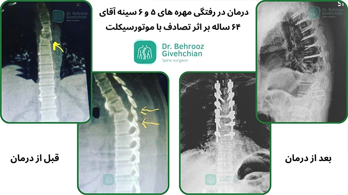 شکستگی مهره ۵ و ۶ ستون فقرات