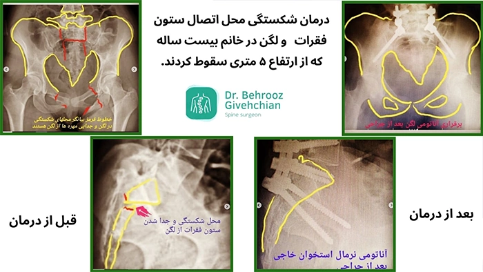 شکستگی تروماتیک ستون فقرات