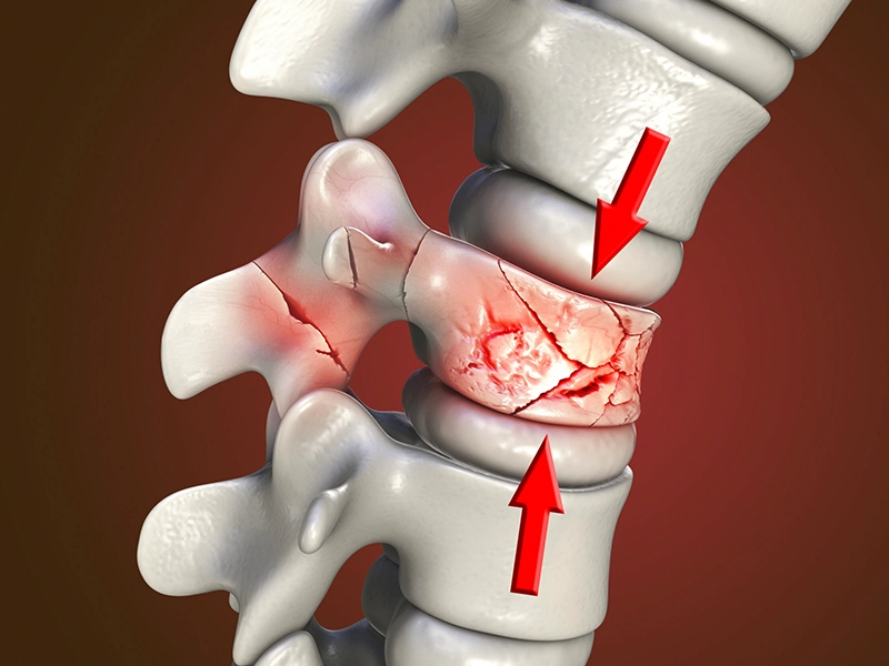 شکستگی مهره کمر
