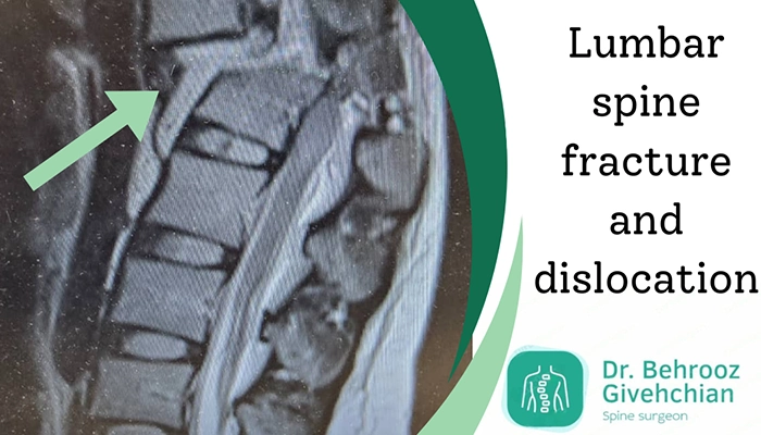 شکستگی مهره کمر