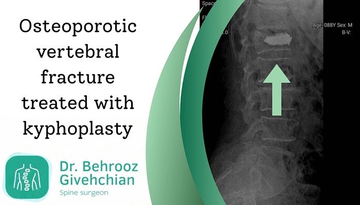 شکستگی مهره کمر ناشی از پوکی استخوان