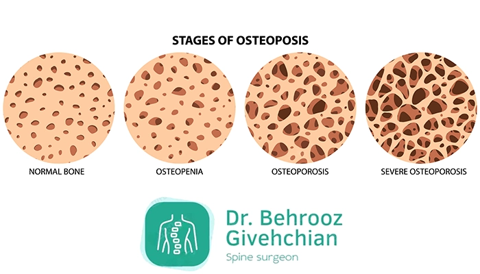 درجات پوکی استخوان