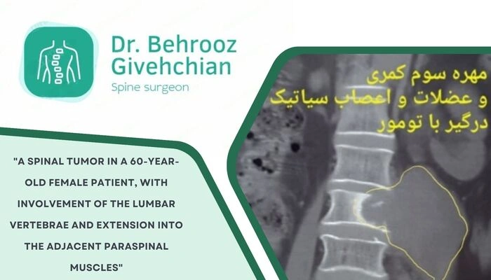 شکستگی پاتولوژیک مهره