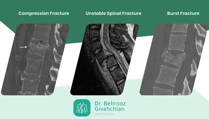 انواع شکستگی پاتولوژیک
