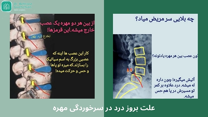 علائم سرخوردگی مهره
