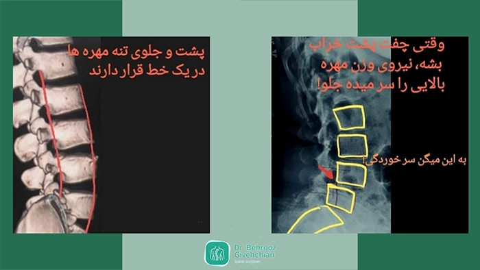 سرخوردگی مهره