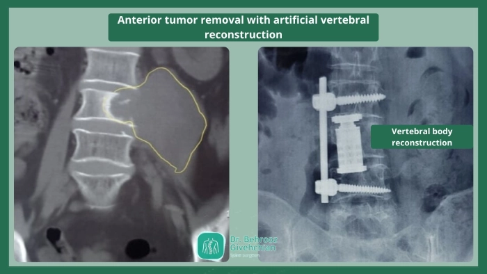 تومور ستون فقرات