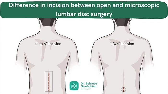 انواع روش های جراحی دیسک کمر