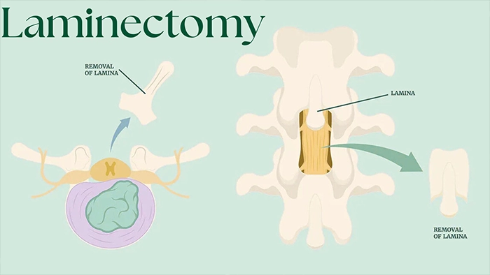 لامینکتومی