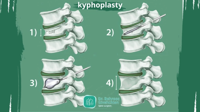 کیفوپلاستی