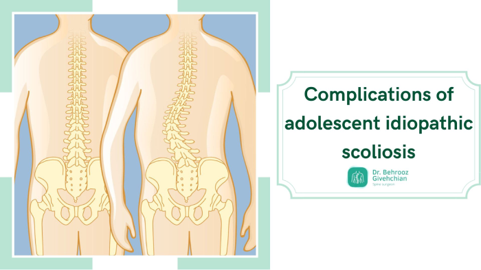 عوارض اسکولیوز ایدیوپاتیک نوجوانان