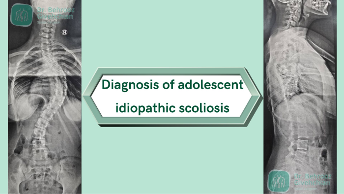 غربالگری اسکولیوز ایدیوپاتیک نوجوانان