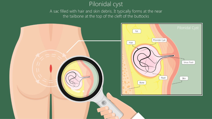 کیست پیلونیدال