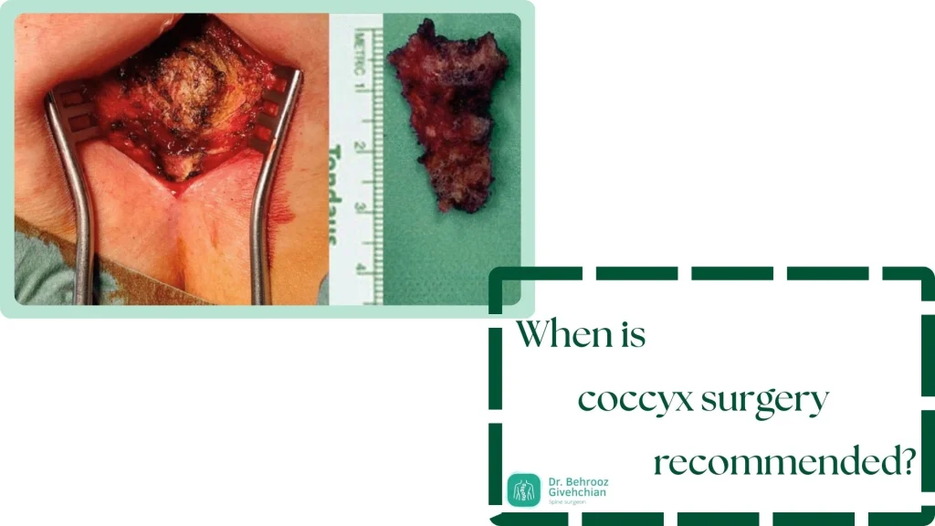 جراحی دنبالچه