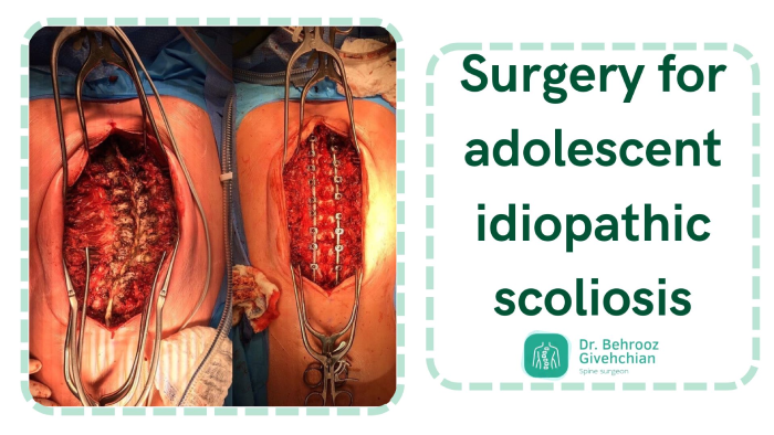 درمان اسکولیوز ایدیوپاتیک نوجوانان