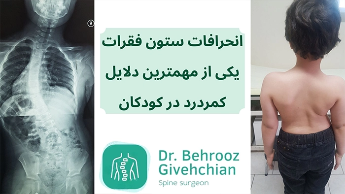 کمردرد کودکان به دلیل اسکولیوز