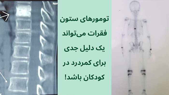 تومورهای ستون فقرات