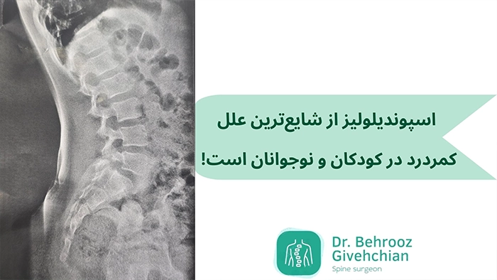 اسپوندیلولیز کودکان
