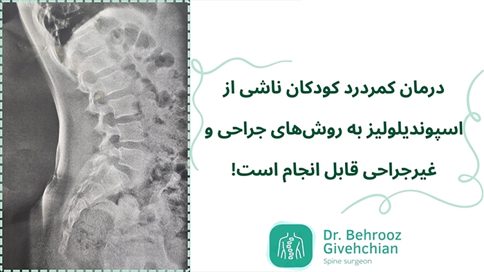 درمان کمردرد ناشی از اسپوندیلولیز در کودکان